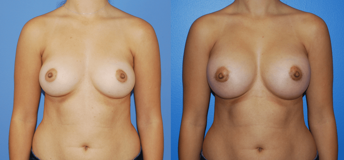 Full C Breast Augmentation 22