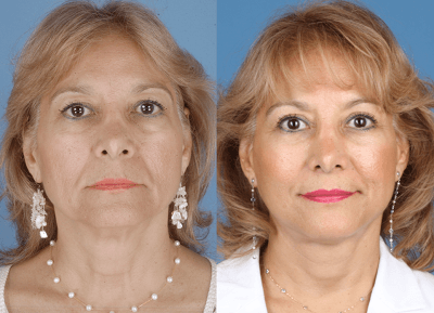 Facelift Surgery_Newport Beach_Beverly Hills_Orange County_Dickinson