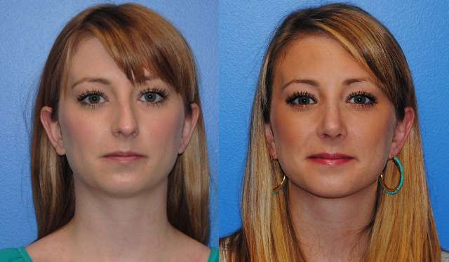 Rhinoplasty Rib Graft Newport Beach
