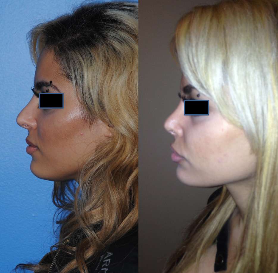 Middle Eastern Rhinoplasty Revision in Newport Beach
