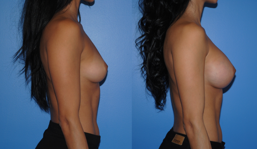 Natural Looking Silicone Breast Implants