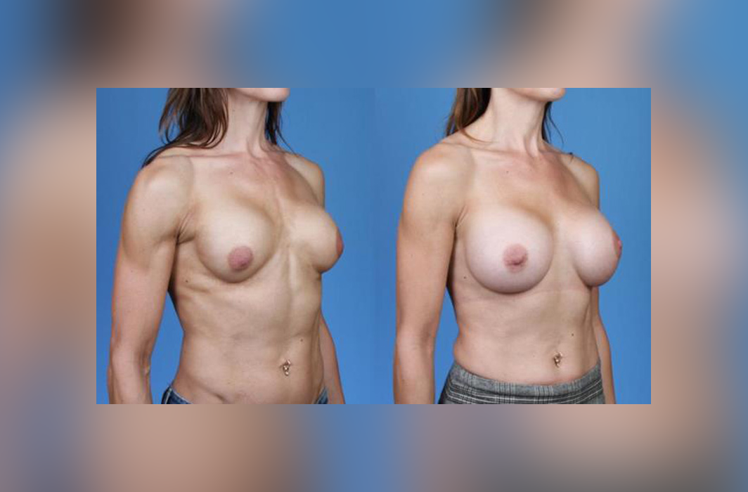 Breast-Augmentation-Elite-Athlete-Dickinson
