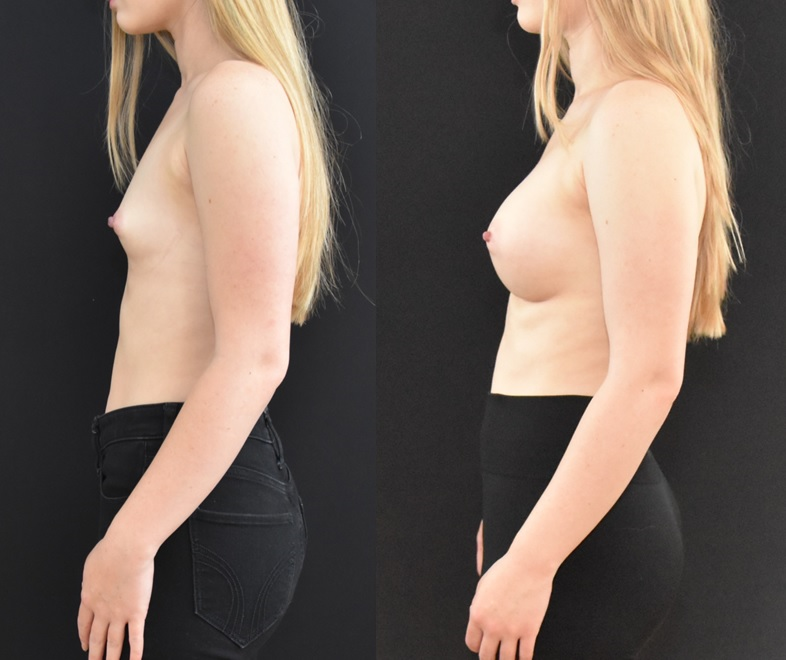 Breast-Augmentation-Side-Before-and-After-Brian-P.-Dickinson-M.D.
