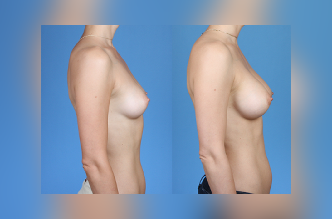 Breast-Augmentation Silicone-Implants_Brian-Dickinson-MD