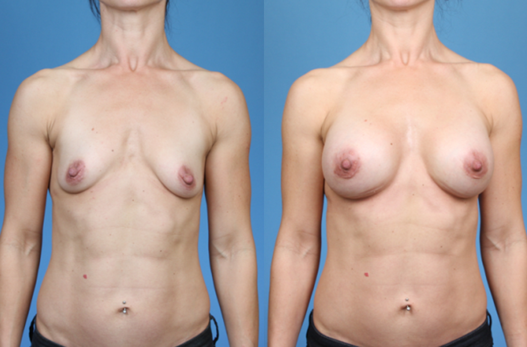 Elite-Athletes_Breast-Augmentation_Newport-Beach_Breast-Implants