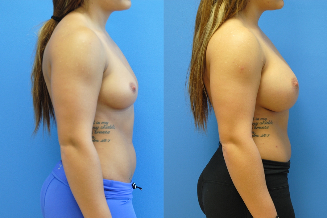 Fitness-Model-Newport-Beach-Breast-Augmentation-plastic-surgeon