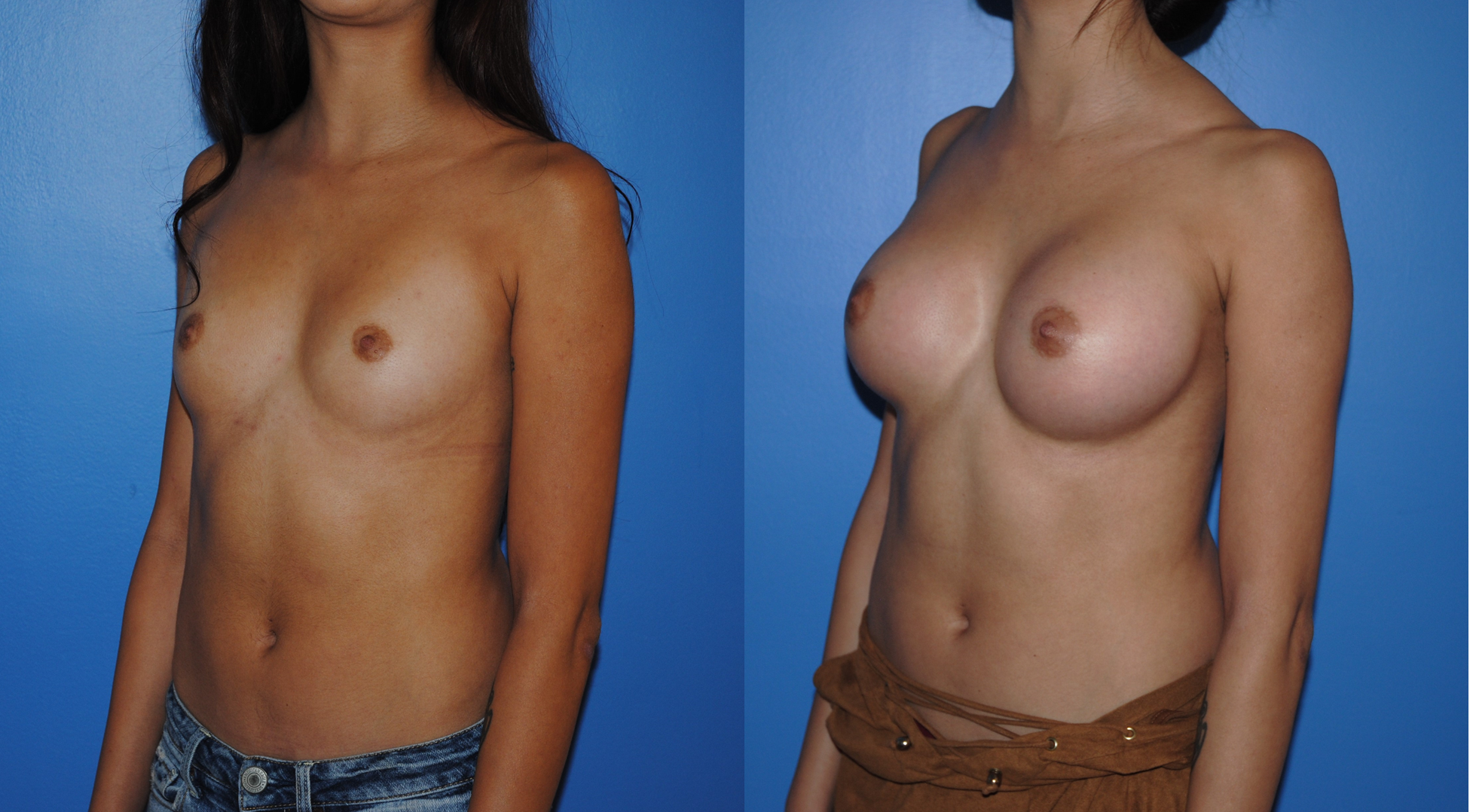 Transax-Breast-Augmentation