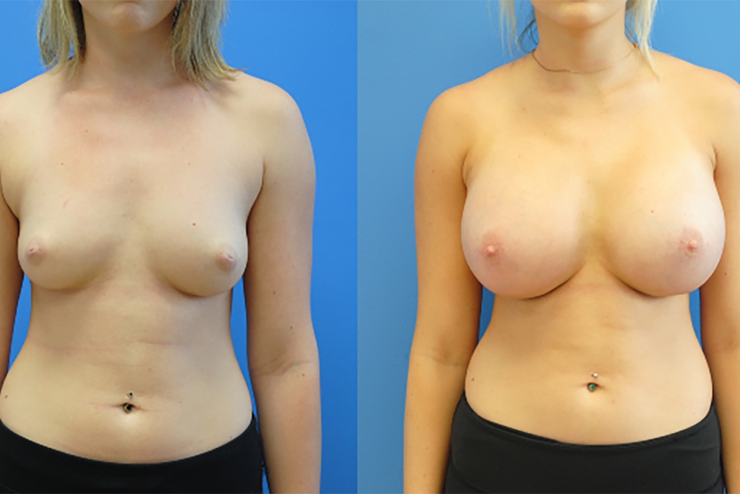 Breast augmentation newcastle cosmetic plastic surgery