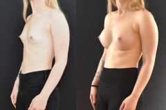 Breast-Augmentation-Oblique-Before-and-After-Brian-P.-Dickinson-M.D.