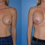 Breast Augmentation-Revision-Newport Beach-Orange County