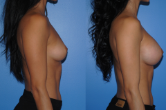 Breast-Augmentation_Silicone-Breast-Implants_Natural-Looking-Breast-Augmentation