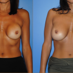 Capsular Contracture-Revision Breast Augmentation Surgery
