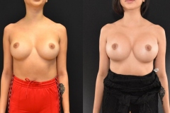 Transaxillary-Breast-Augmentation-Implant-Replacement