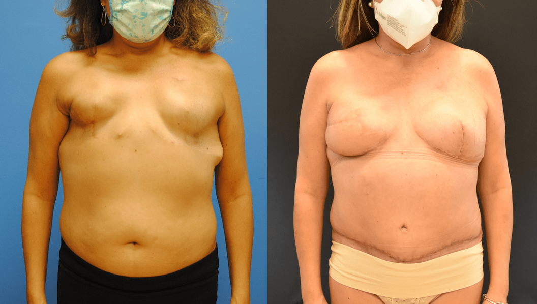 Bilateral-DIEP-Flap-Breast-Reconstruction-after-Right-Radiation-Therapy-with-Oncoplastic-Split