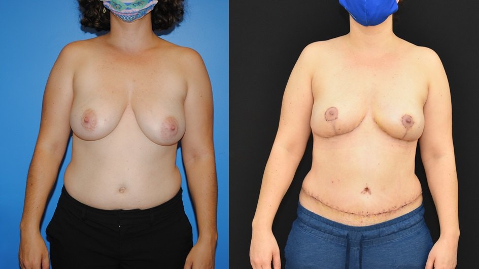 Bilateral-DIEP-Flap-Reconstruction-Nipple-Preservation