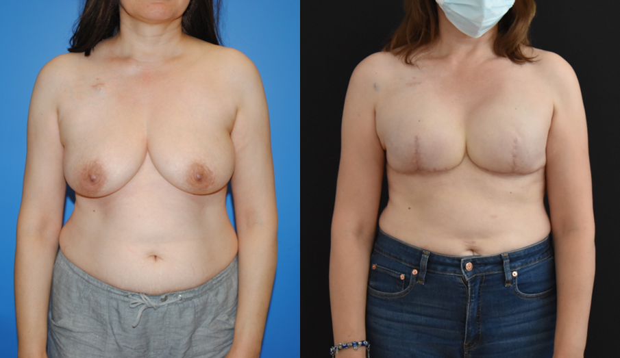 Bilateral-Mastectomy-Recoonstruction-Expander-Implant-Reconstruction