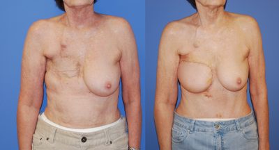 Breast Reconstruction TRAM Flap