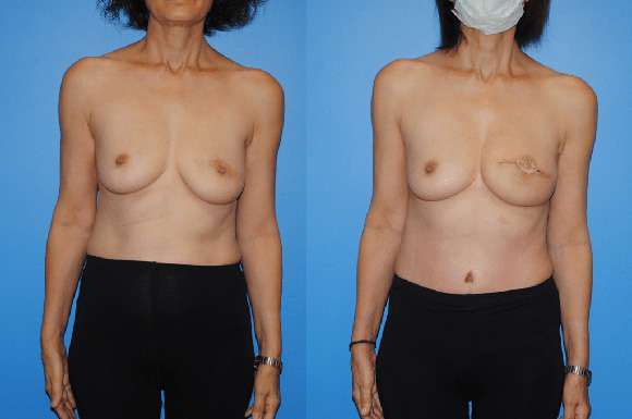 DIEP-Flap-Mastectomy-Reconstruction-580x385jpg