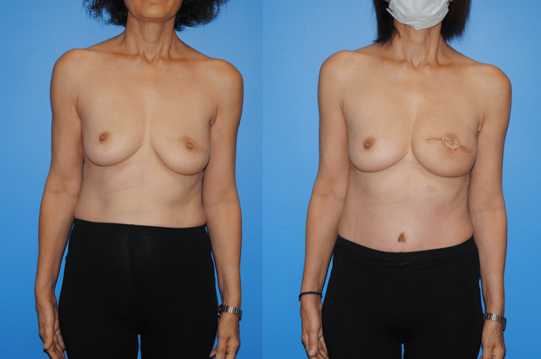 DIEP-Flap-Mastectomy-Reconstruction
