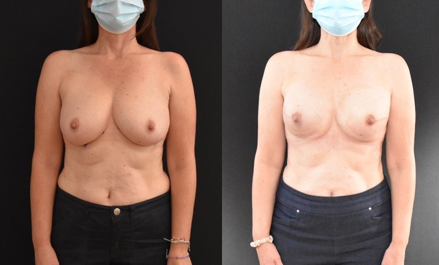Implant-Breast-Reconstruction-Tissue-Expanders-to-Implants-1