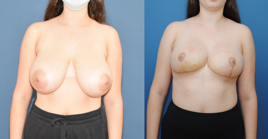 Breast-Reduction-Before-and-After-Brian-Dickinson-M.D.