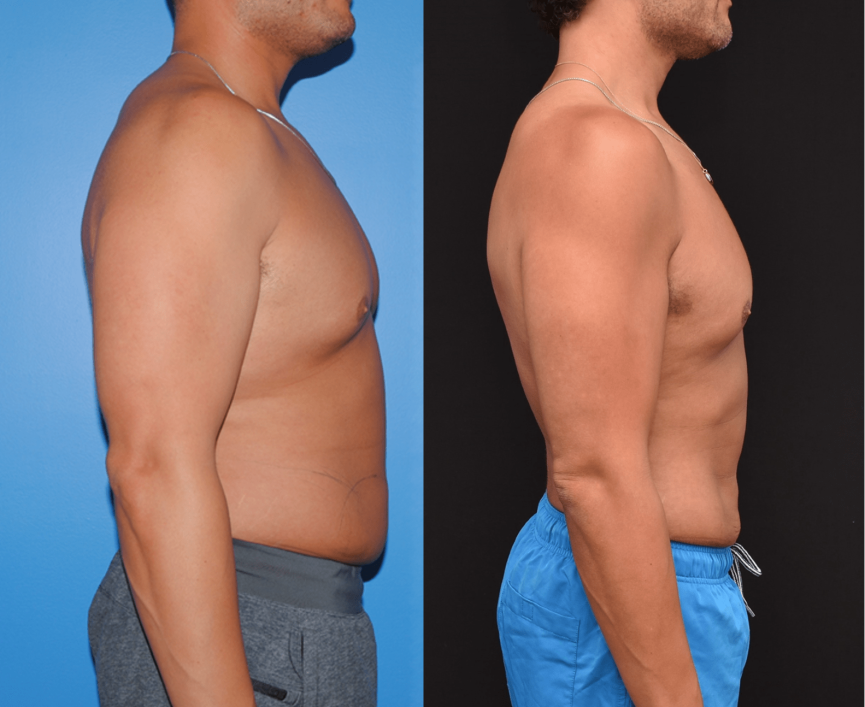 Flank-Abdomen-Liposuction-Brian-P.-Dickinson-M.D.