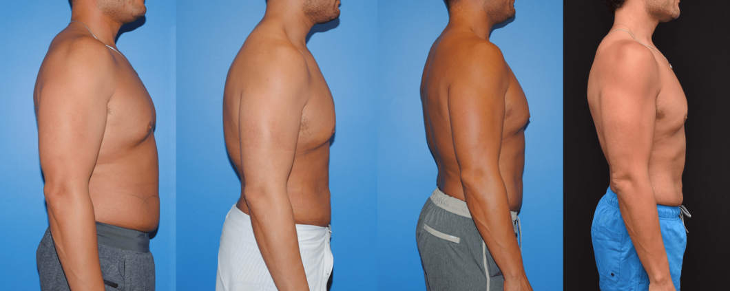 Flank-Abdomen-Liposuction-Progression-Liposuction-Healing-Takes-Time-A-Work-in-Progress-Brian-P.-Dickinson-M.D.
