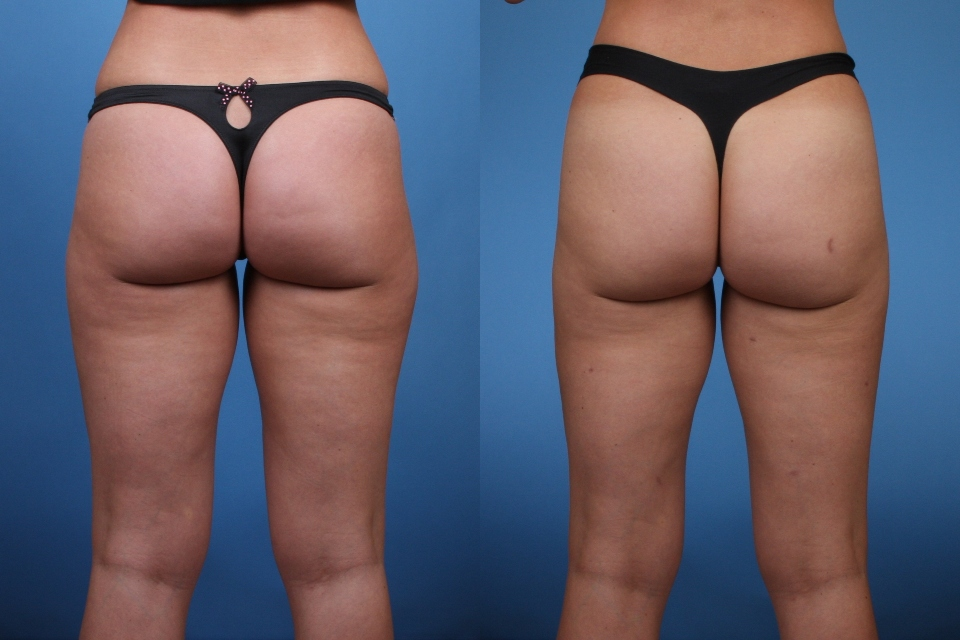 Inner-Outer-Thigh-Liposuction