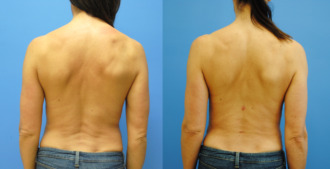 Lower-Back-Liposuction