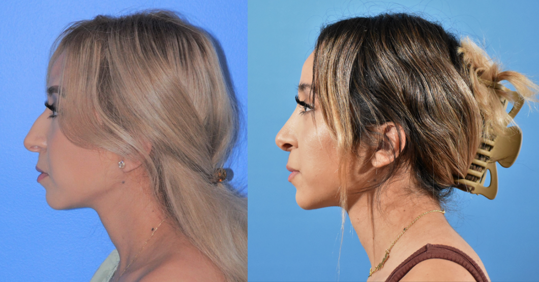 Rhinoplasty-Before-After-Brian-Dickinson-M.D.