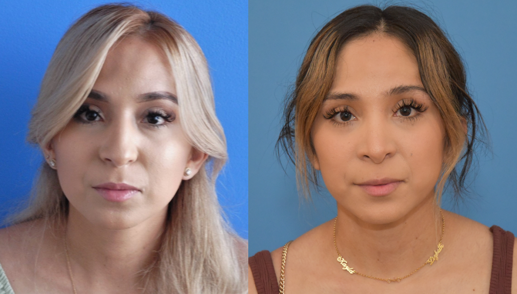 Rhinoplasty-Tip-Refinement-Before-After-Brian-Dickinson-M.D.