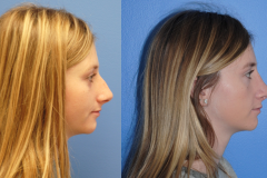 Rhinoplasty-Dorsal-Hump-Reduction-Natural-Results
