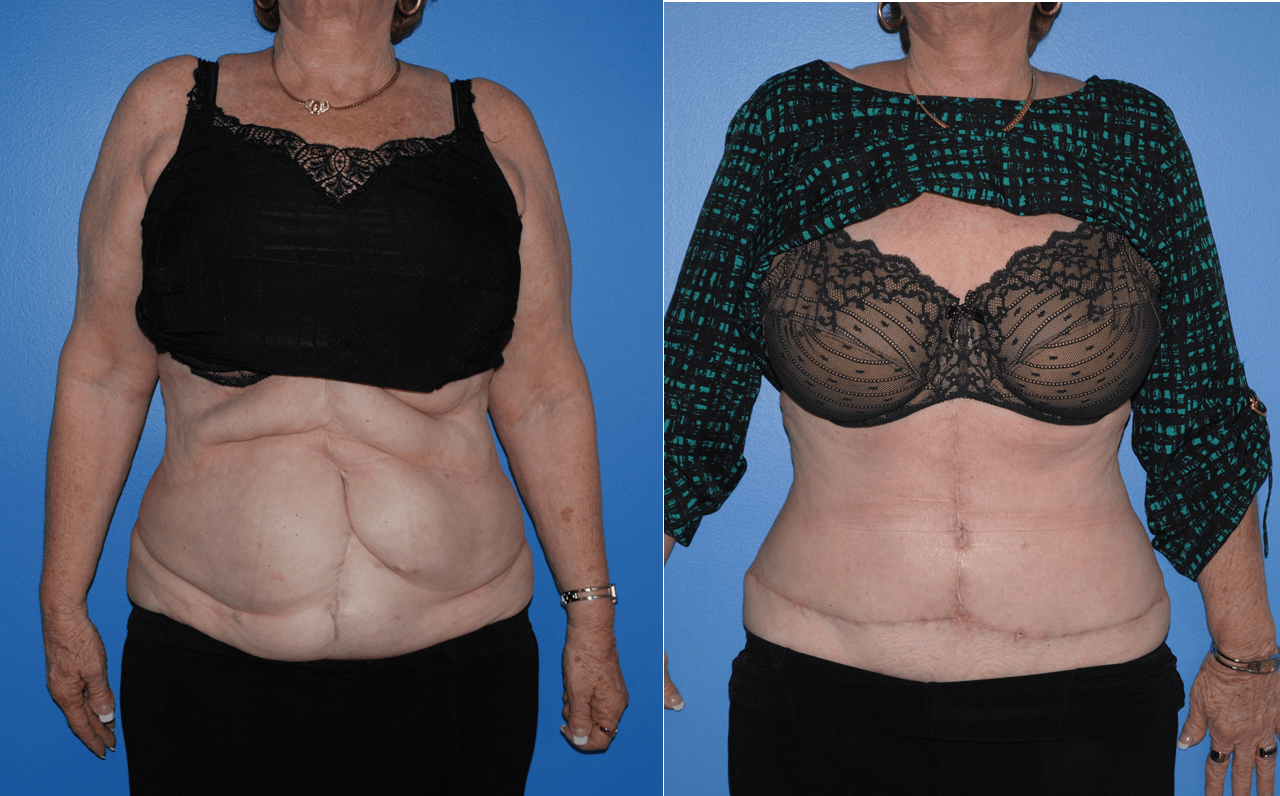 Incisional Hernia Before And After Pictures