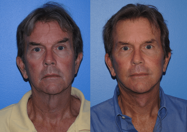 Facelift Surgery Males