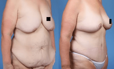 Post Bariatric Body Contouring _NB
