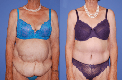 Post Bariatric Body Contouring Post Bariatric Body Contouring