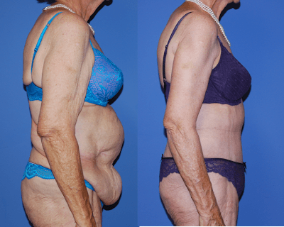 Post Bariatric Body Contouring_NB