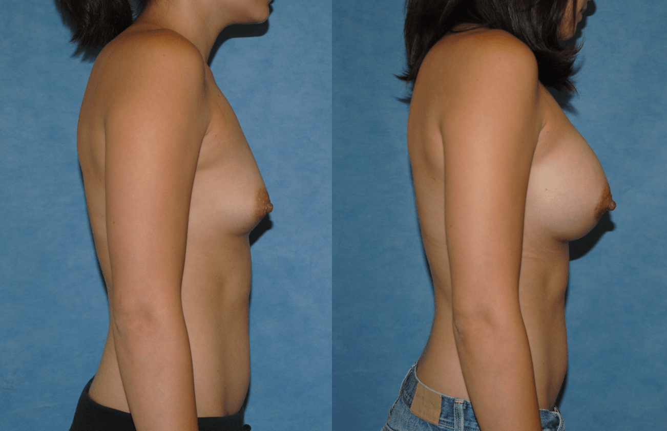 Breast Augmentation-Orange County-Brian Dickinson M.D.-Saline Implants