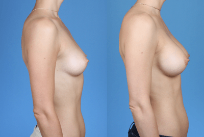 Below the Muscle and Breast Crease Augmentation