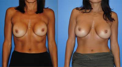 Capsular Contracture Breast Reconstruction Newport Beach