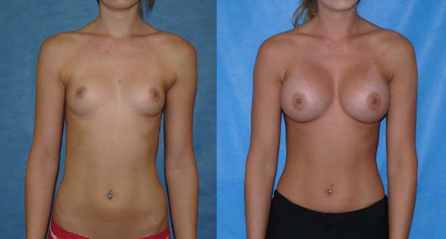 Silicone Breast Implants Augmentation