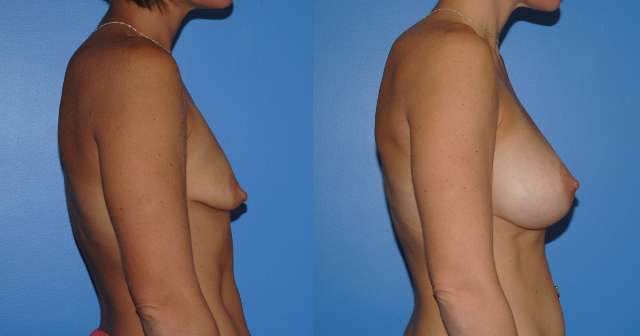 Tuberous Breast Deformity Breast Reconstruction