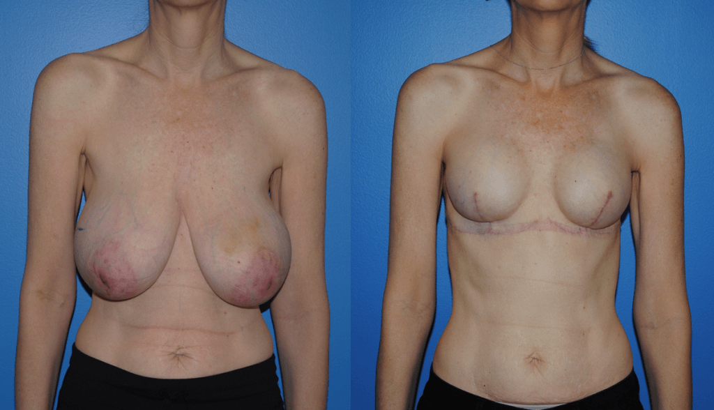 Breast Reconstruction with Tissue Expander and Implant Reconstruction