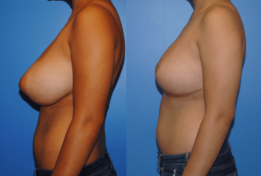 Breast Reduction Los Angeles.