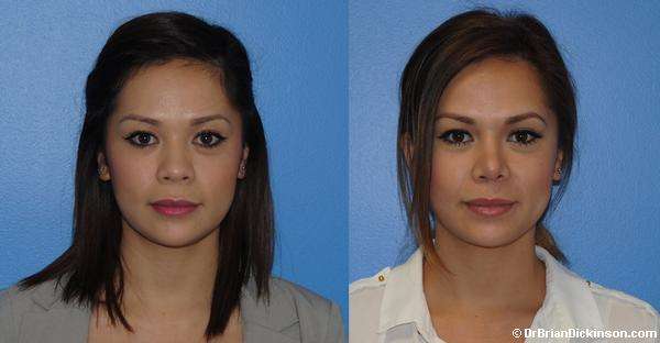 Asian rhinoplasty in Newport Beach