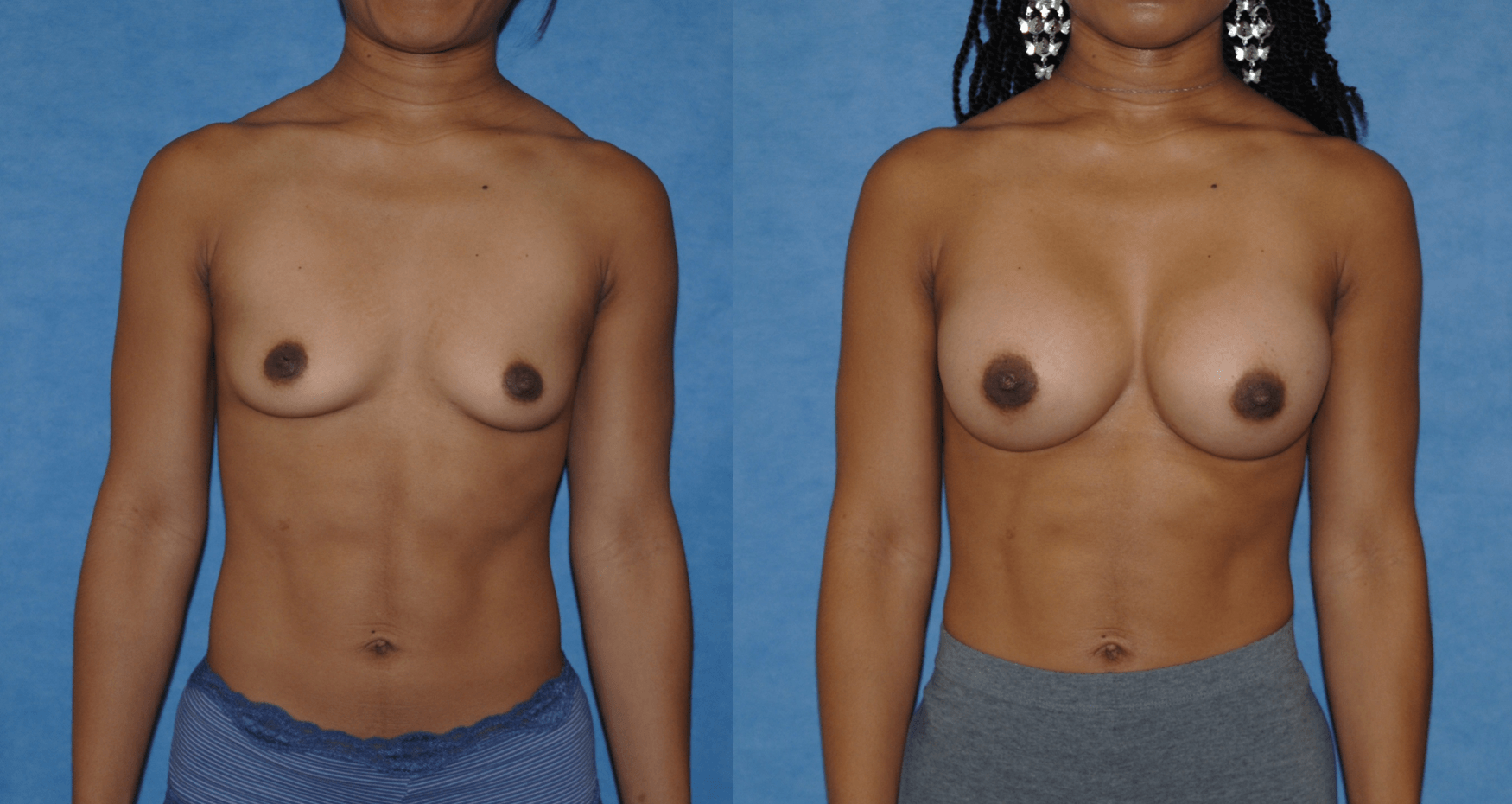 Breast implant revision
