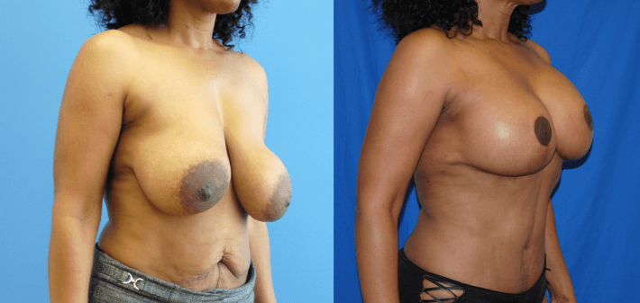 Removal and Replacement of Breast Implant with Breast Lift