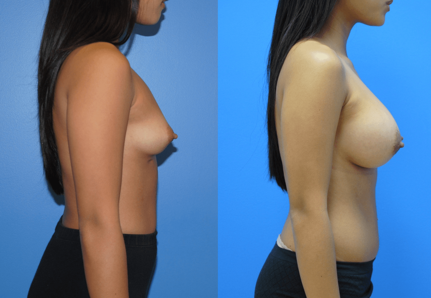 Breast Reconstruction-Orange County
