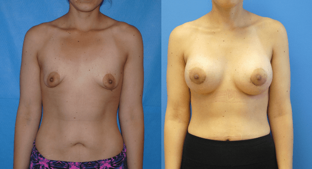 Breast Augmentation-Orange County-Tuberous Breast Deformity-Brian Dickinson, M.D.