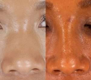 African American Rhinoplasty Newport Beach
